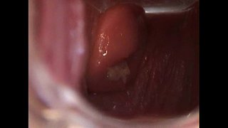 Avy Mbukak Pus karo Speculum